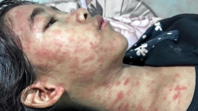 Ιός chikungunya: Τρομάζει η «νέα κινεζική πανδημία» με ήδη 10.000 κρούσματα - Πρόστιμα και μπαράζ μέτρων για τους πολίτες