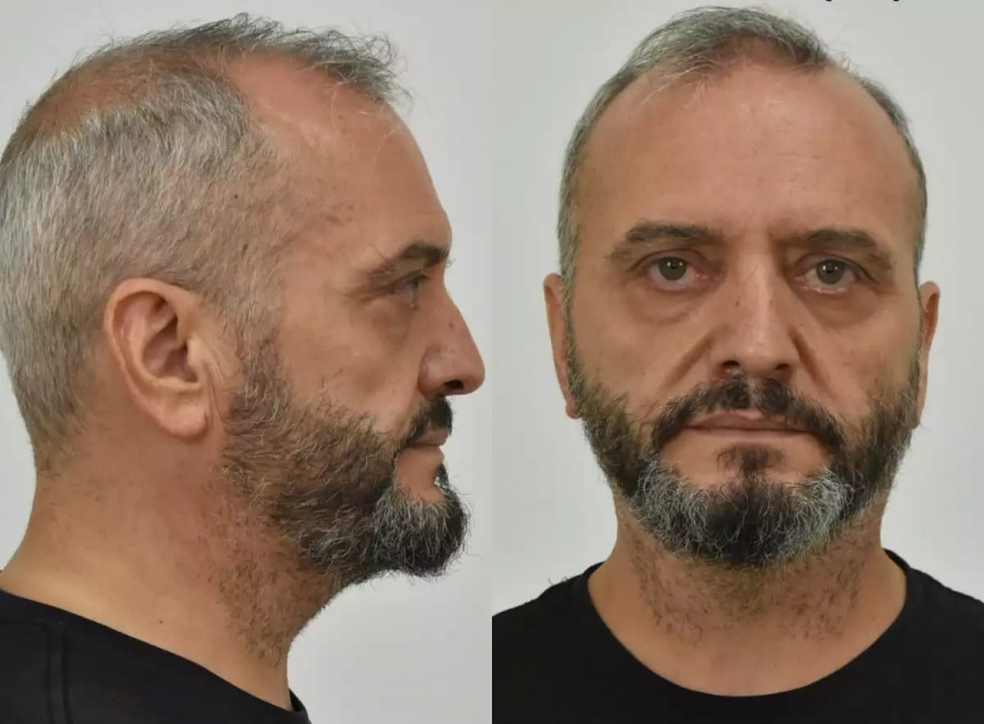 Κολωνός: Ο Μπακογιάννης διέγραψε από την δημοτική παράταξη την σύζυγο του 53χρονου